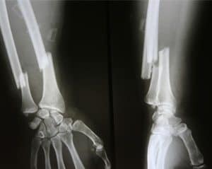 X-rays of broken bones, one of the side effects of Nexium use