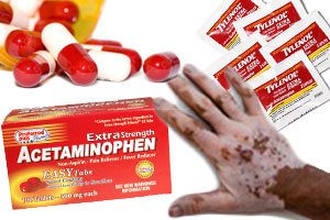 Acetaminophen deadly skin disorders