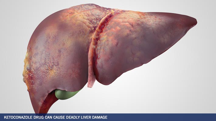 Ketoconazole can cause deadly liver damage risk