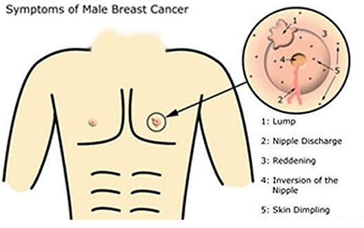 male breast cancer signs symptoms