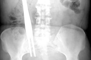 Jury awards $5.6 million to man who had screwdriver shaft implanted in his back by surgeon