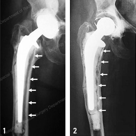 Depuy hip implant side effects may be linked to revision surgery lawsuits