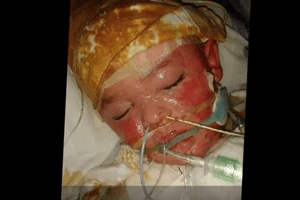 Young boy suffering from stevens-johnson syndrome after taking epilepsy drug
