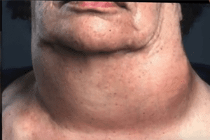 Thyroid cancer rates near indian point
