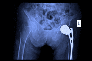 DePuy ASR Metal-on-Metal Hip Implant Lawsuits