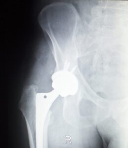 Stryker Rejuvenate, ABG II Hip Implant Settlement Expanded