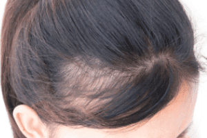 Hair Loss After Taxotere Chemotherapy - Parker Waichman LLP