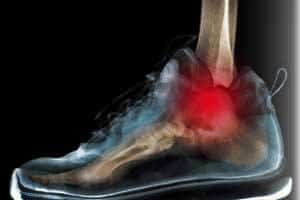 Skechers Shape-Ups Toning Shoe Injuries