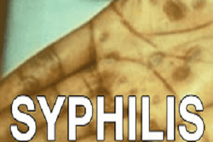 Suit says Guatemalans purposely infected with syphilis