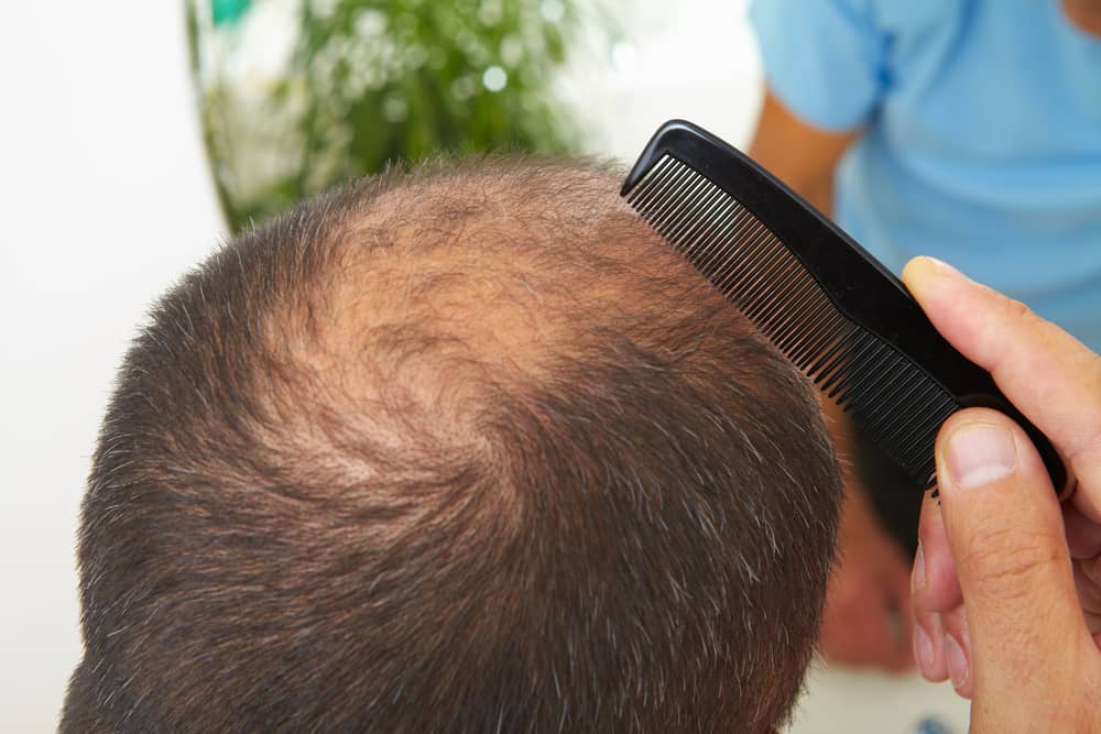 Hair Loss Drug May Lead to Depression - Parker Waichman LLP