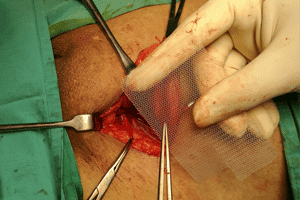What Is Surgical Mesh That Is Used In Hernia Mesh Surgery?