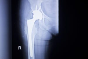 Stryker Metal-on-Metal Hip Implant Lawsuits Consolidated