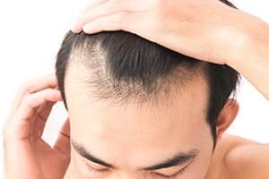 Hair Loss Treatments and Revised Side Effects