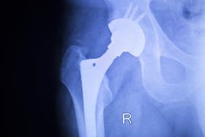 MoM Hip Replacement Recipients to Monitor and Follow-Up