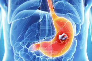 Common Medication May be Linked to Increased Gastric Cancer Risk