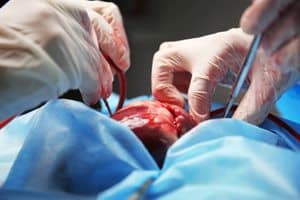 Pursuing Claims Involving Defective Johnson & Johnson Heart Device