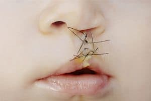 Topiramate Cleft Lip or Palate Birth Defect 