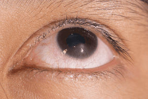 Stem Cell Eye Treatment Injury