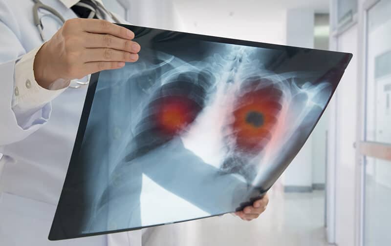 Doctor examining x-ray of lung cancer from ace inhibitor toxicity