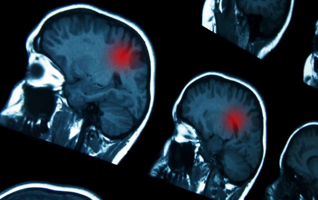 Image of brain tumor that will undergo NeuroBlate surgery