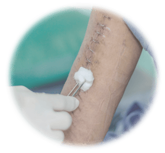 Surgical stapler and implantable staple lawsuits