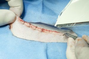 FDA Sends Letter to Healthcare Providers About Surgical Stapler, Staple Risks