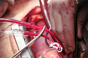 IntraClude Intra-Aortic Device Used in Cardiopulmonary Bypass Recall ed