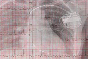 Abbott Ellipse Implantable Cardioverter Defibrillators Labeled as Class I Recall