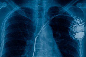 FDA Reports Medtronic Pacemaker Batteries Die Without Warning