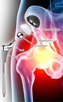 DePuy ASR Hip Implants, Other Faulty Medical Devices Subject to Little FDA Oversight, Investigation Finds
