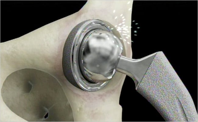 DePuy-Hip-Implant-Settlement