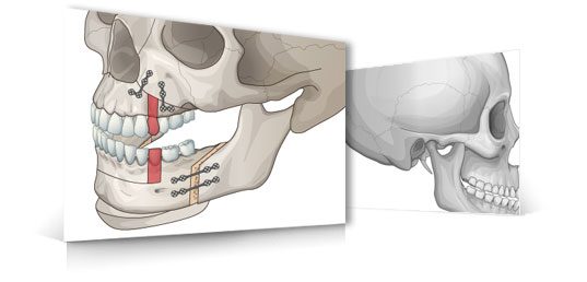 DePuy-Synthes-Jaw-Stabilizing-System