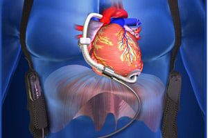 HeartWare to Recall Ventricular Assist System