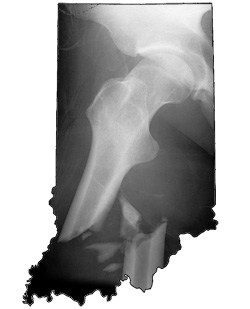 Indiana Woman Files Fosamax Lawsuit Following Pair of Femur Fractures
