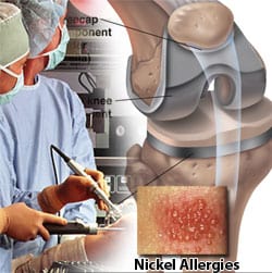 Knee Replacement Patients Should Consider Nickel Allergies before Surgery