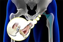 Lawsuits over DePuy ASR Metal-on-Metal Hip Implants Continue to Mount
