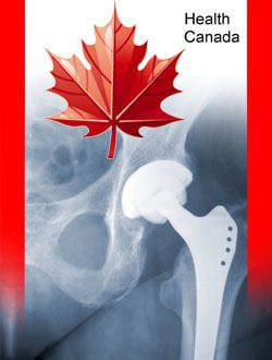 Metal-on-Metal Hip Replacement Concerns Grow in Canada
