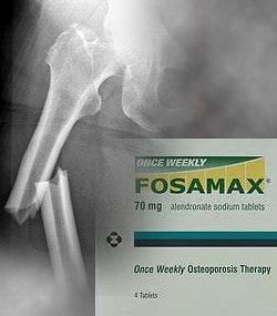 Mississippi Woman Alleges Use of Fosamax Led to Femur Fracture