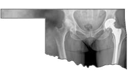 Oklahoma Woman Latest to Head to Court Over Alleged DePuy ASR Hip Implant Injuries