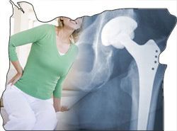 Oregon Woman’s Lawsuit Claims Injury From Biomet Metal-on-Metal Hip Implant