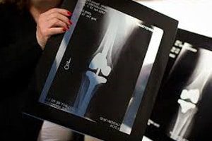 Unapproved Knee Replacement Device Used in Surgeries