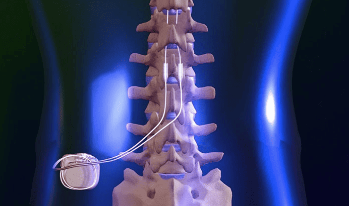 Paralysis_Potential_in_Spine_Stimulators