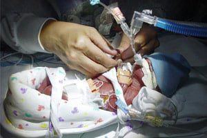 Warning - Lung Condition in Infants Treated with Proglycem