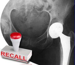Stryker Issues Voluntary Recall for Rejuvenate Modular and ABG II Hip Implant Components