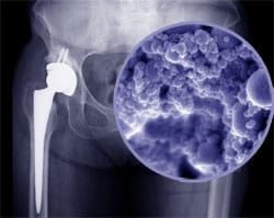 Toxic Nano-Particles from Failing Metal-on-Metal Hip Replacements May Pose Long-Term Health Risks