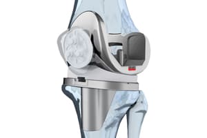 Zimmer Recalls Knee Replacement Device