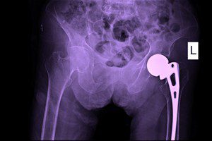 Biomet Faces New Lawsuit over Metal-on-Metal Hip Implant