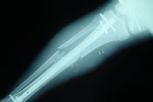 Invokana Increases Risk of Bone Fractures