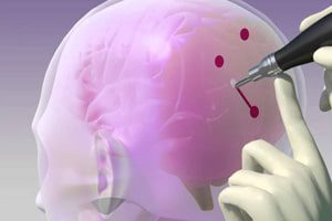 Cranial Perforators May Fail to Disengage