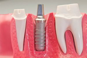 dental_implant_migrates_into_sinus_cavity